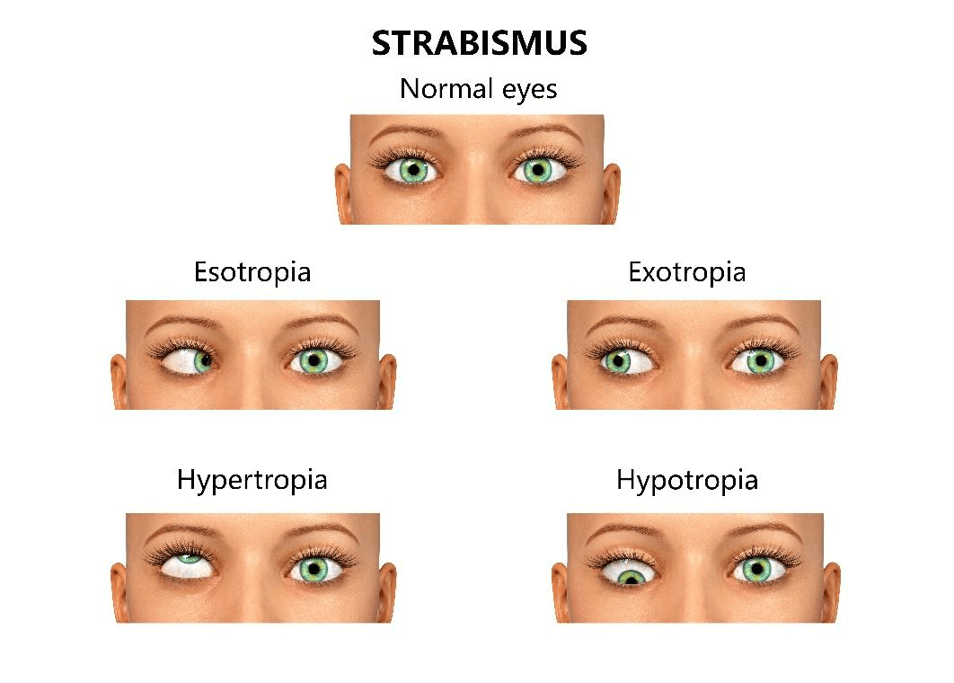 Strabismus Strabismus